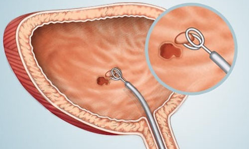 靶向治疗膀胱癌:BioClin获B轮融资3千万美元