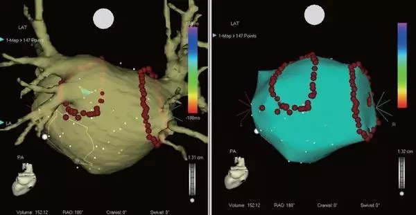 西班牙医械公司MedLumics专治“心动”:并获2亿多元融资