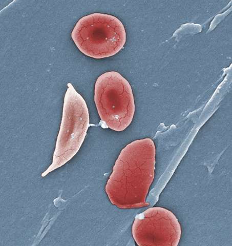 世界首例：法国科学家通过基因疗法治愈镰状细胞贫血症