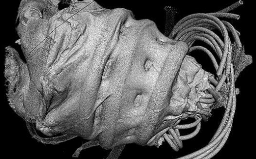 美国发明新型环抱心脏起搏器