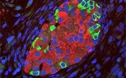 疯狂的T细胞告诉你：为何会患I型糖尿病