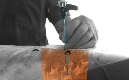 飞利浦研发增强现实导航医疗设备助力微创手术