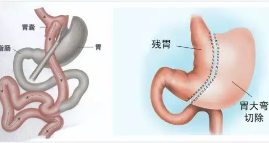 数字医疗临床试验证明II型糖尿病可逆转