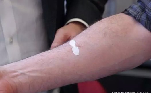 缝合伤口的“创可贴”将取代传统的针线方法