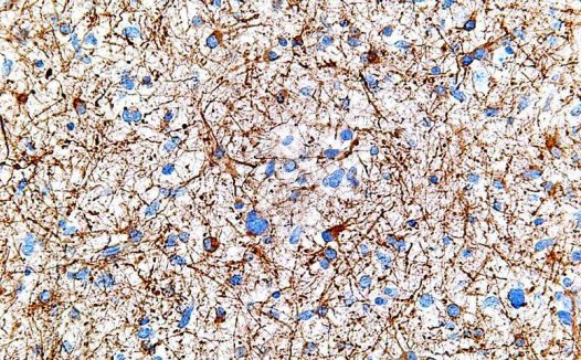 科学家发现控制脑瘤生长的关键基因ZEB1